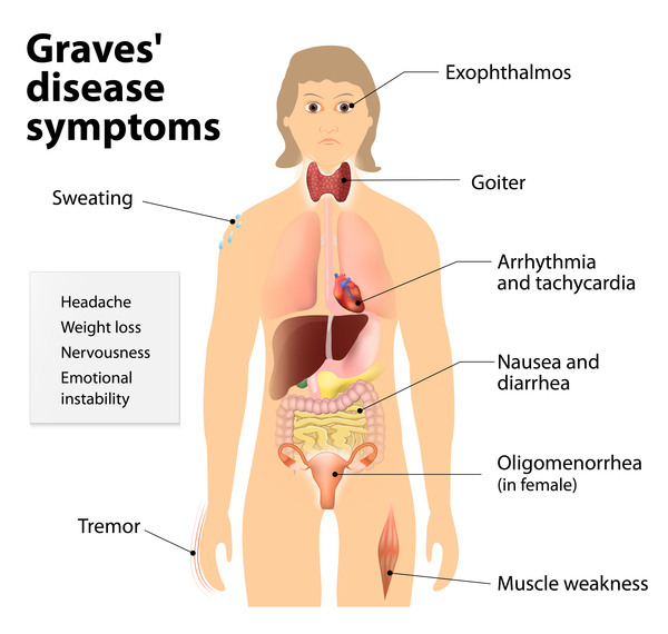 graves-disease-symptoms-onegravesvoice